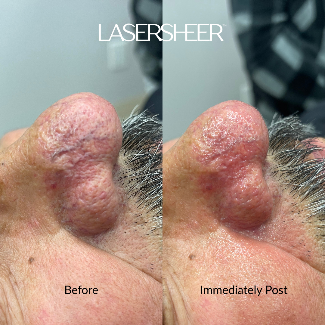 Nose Vein Laser, rhinophyma Edmonton