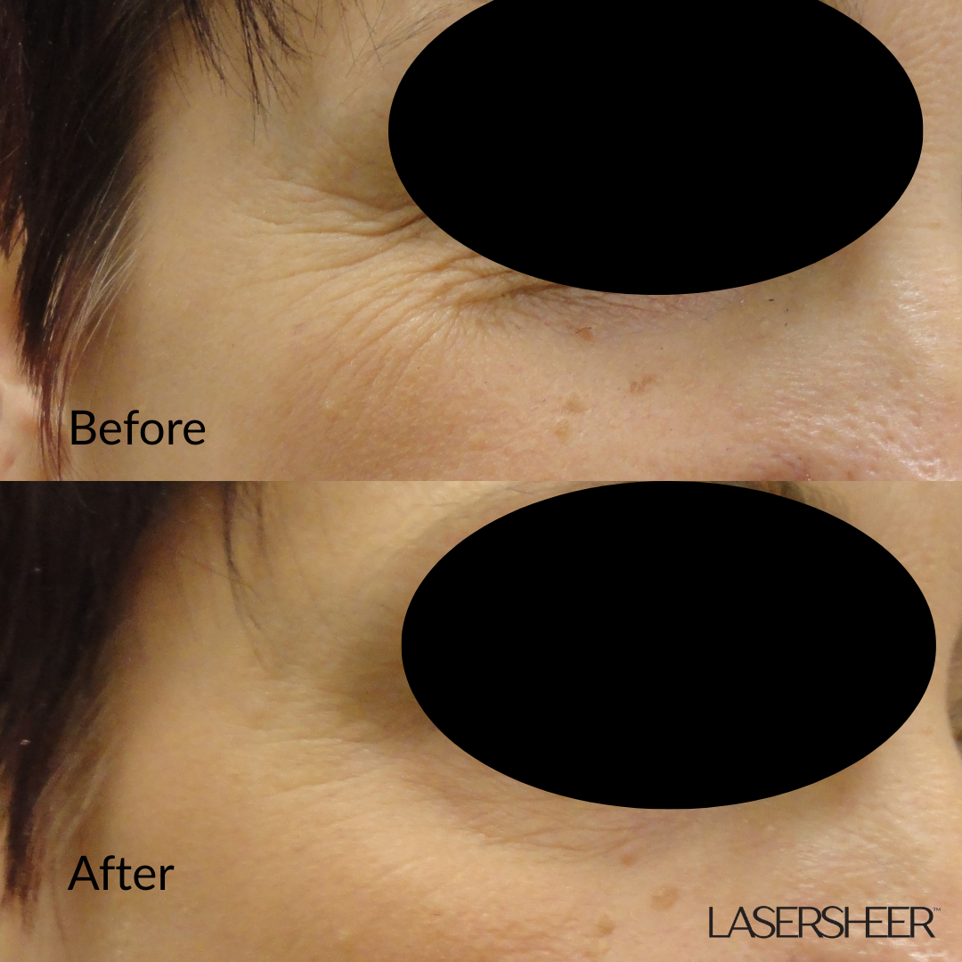 Botox dysport Edmonton Neuromodulator