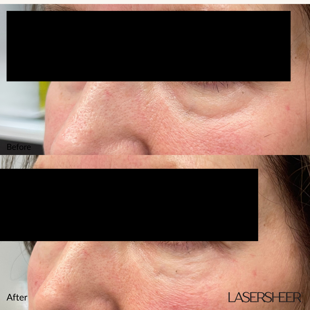 Filler Edmonton St. Albert