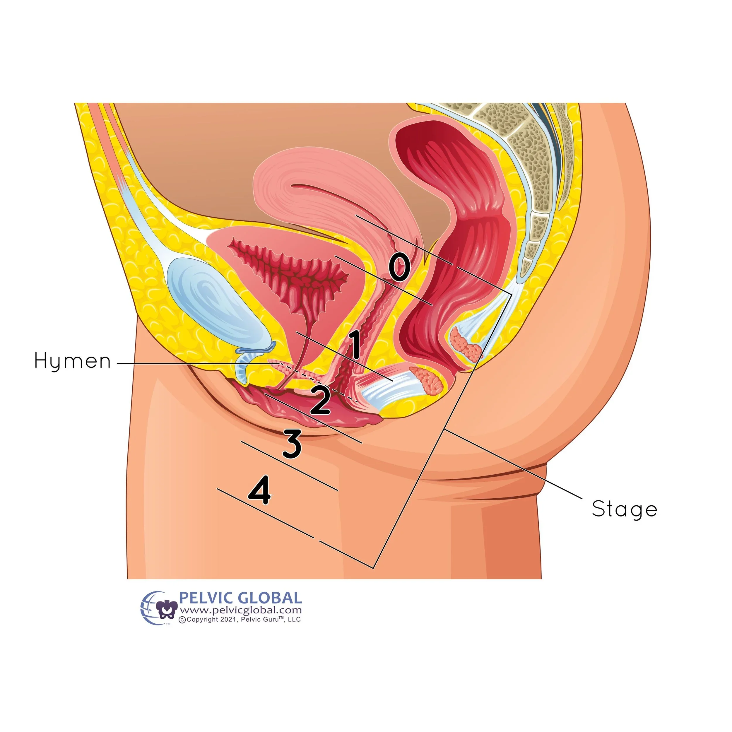 Diagram showing the stages of pelvic organ prolapse from stage 0 to stage 4.