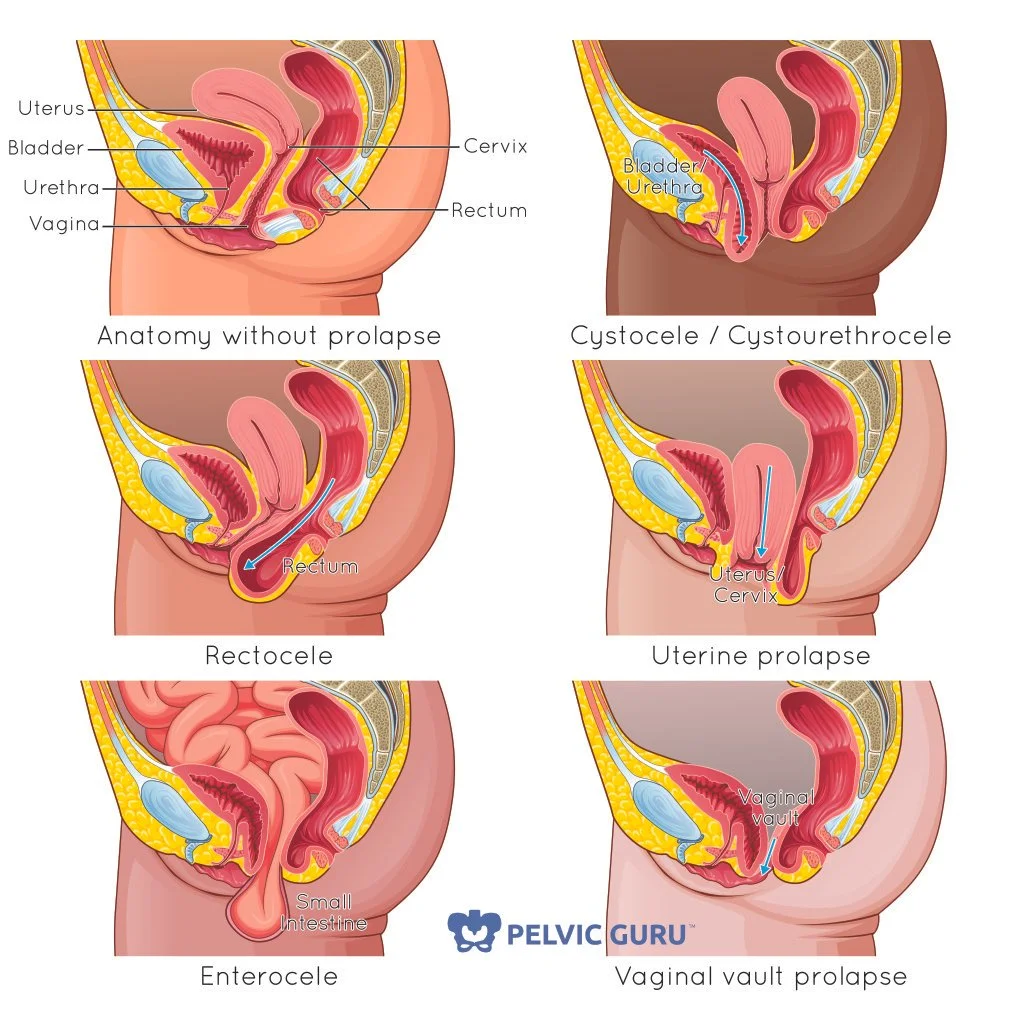 Anatomical illustrations of different types of pelvic organ prolapse
