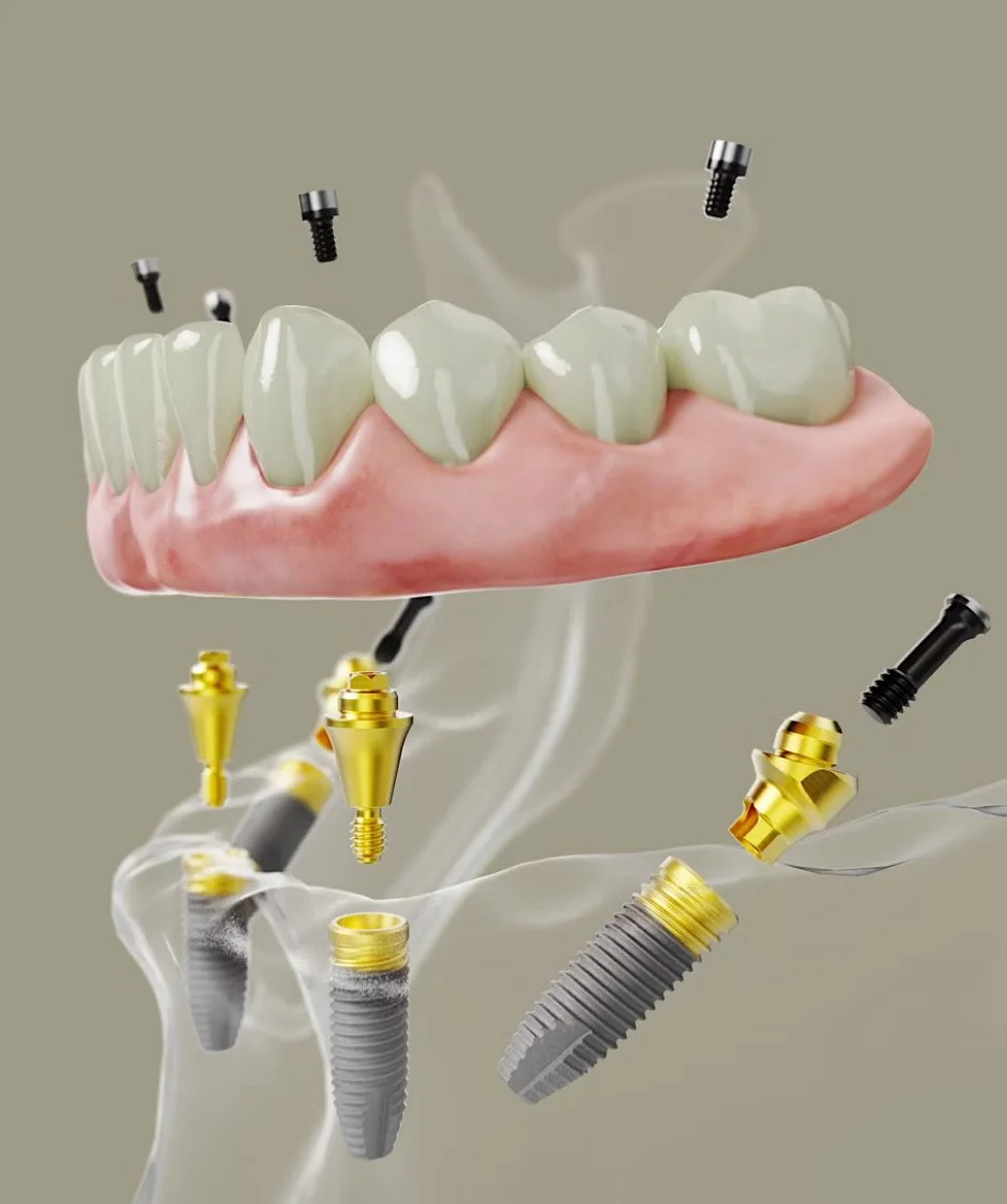 A New Smile in a Day: Full Arch Dental Implants at Hawaii Elite OMS