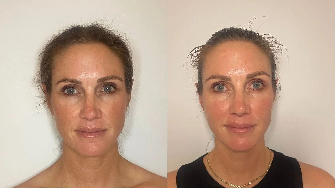 Facelift facial Perth 