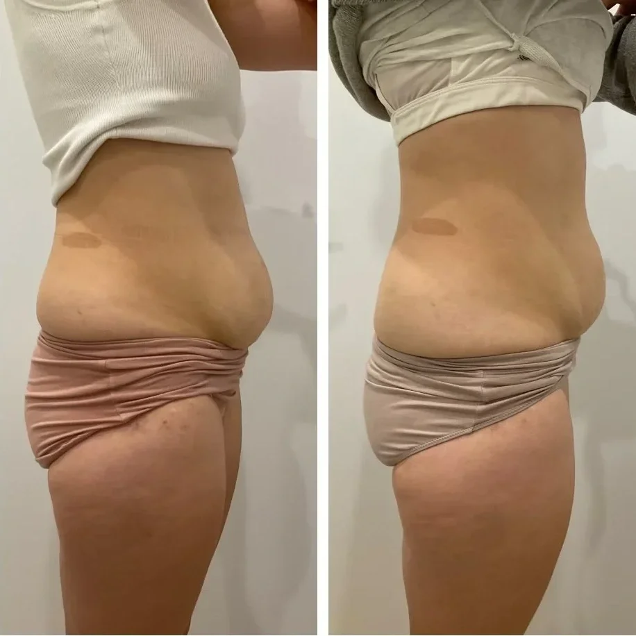 Before and After Sienna Cary Stomach Body Contouring