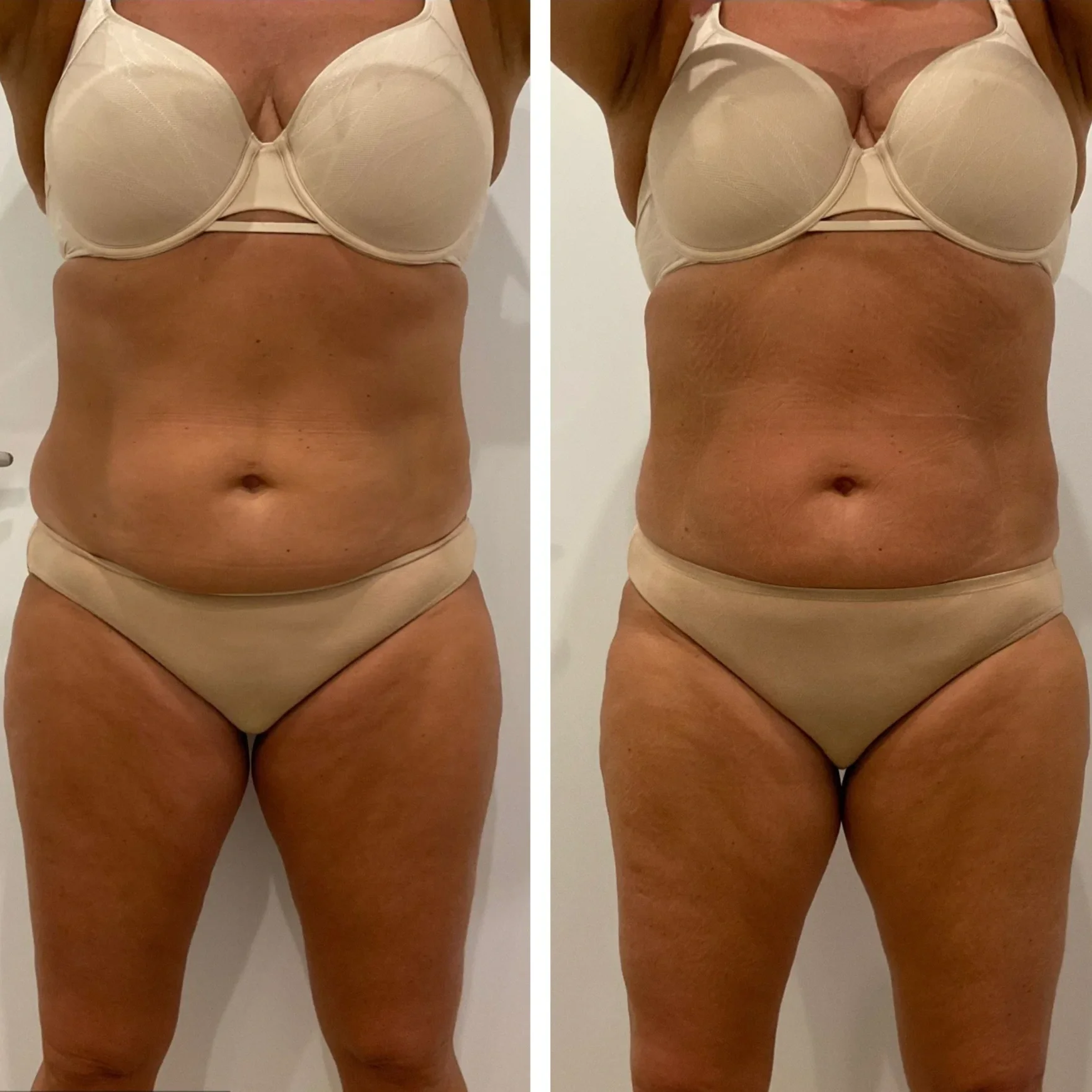 Before and After Sienna Cary Body Contouring