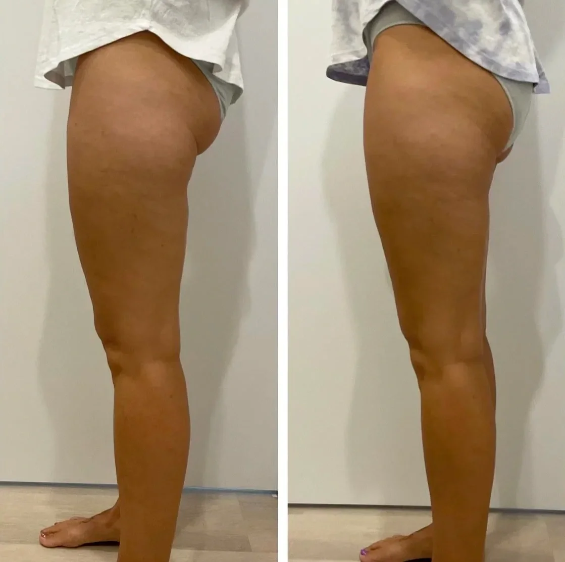 Before and After Sienna Cary Thigh Body Contouring