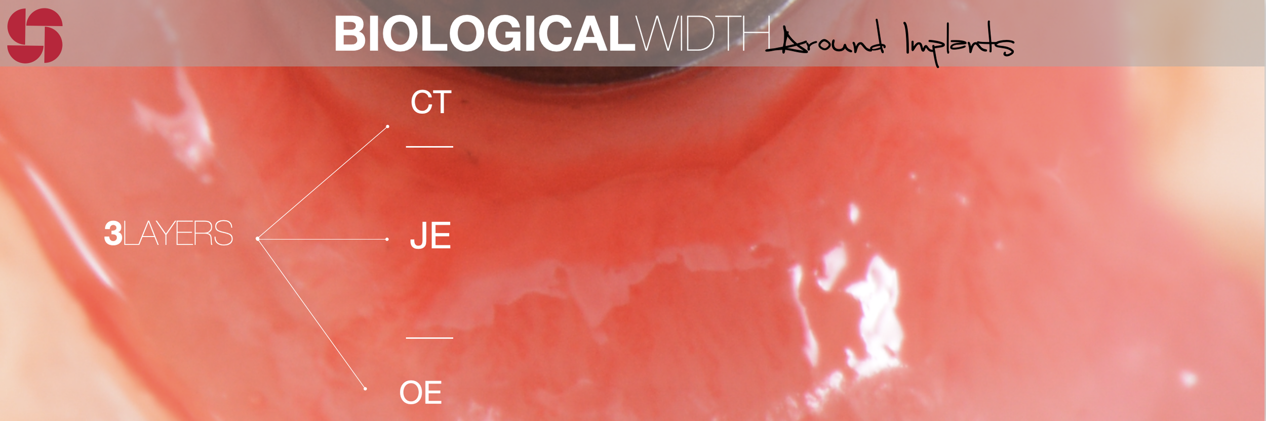 Biological Width 1.png