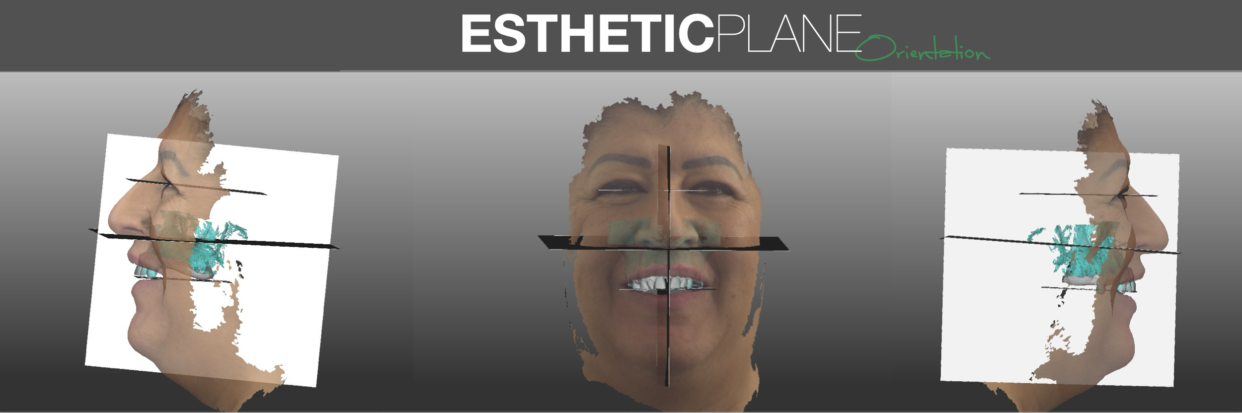 Esthetic Plane Orientation.png