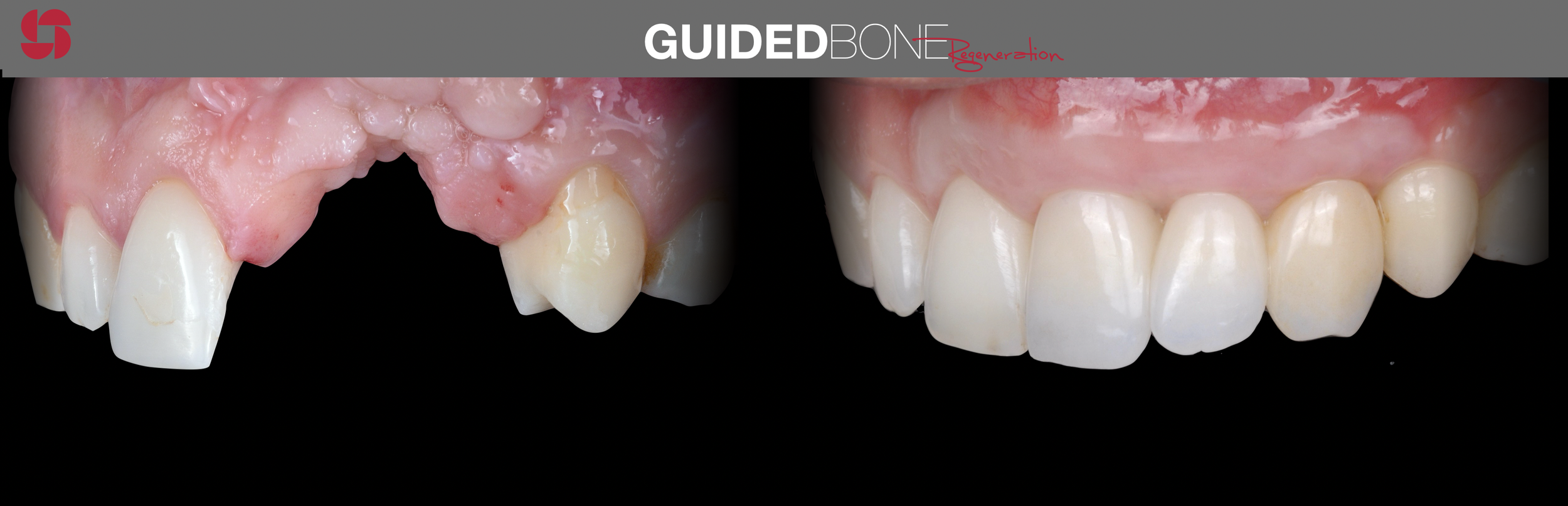 Guided bone regeneration 3.png