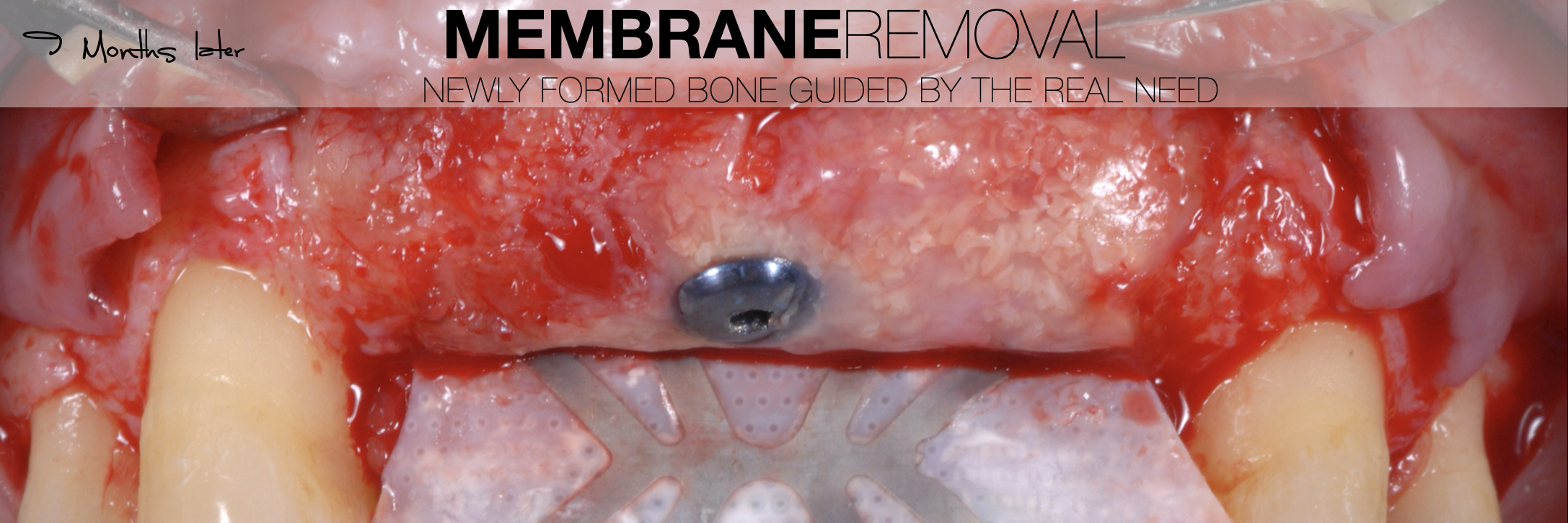 Membrane removal.png