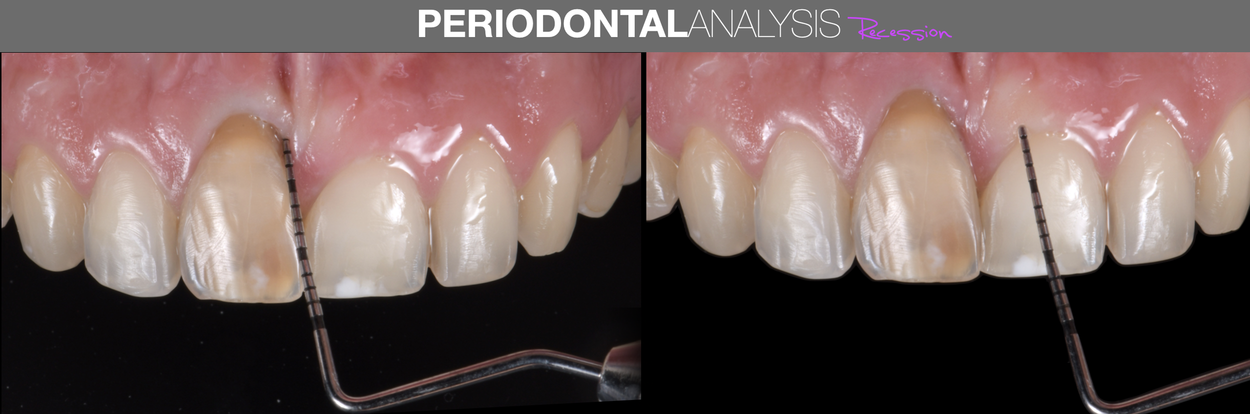 Periodontal  Analysis.png