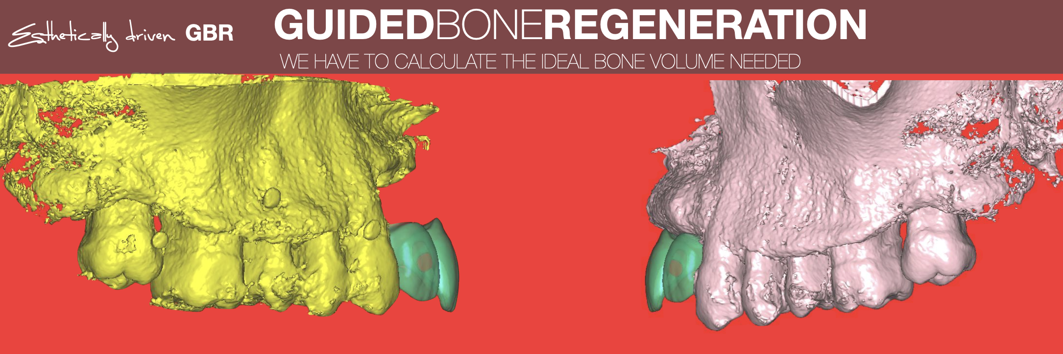 Guided bone regeneration.png