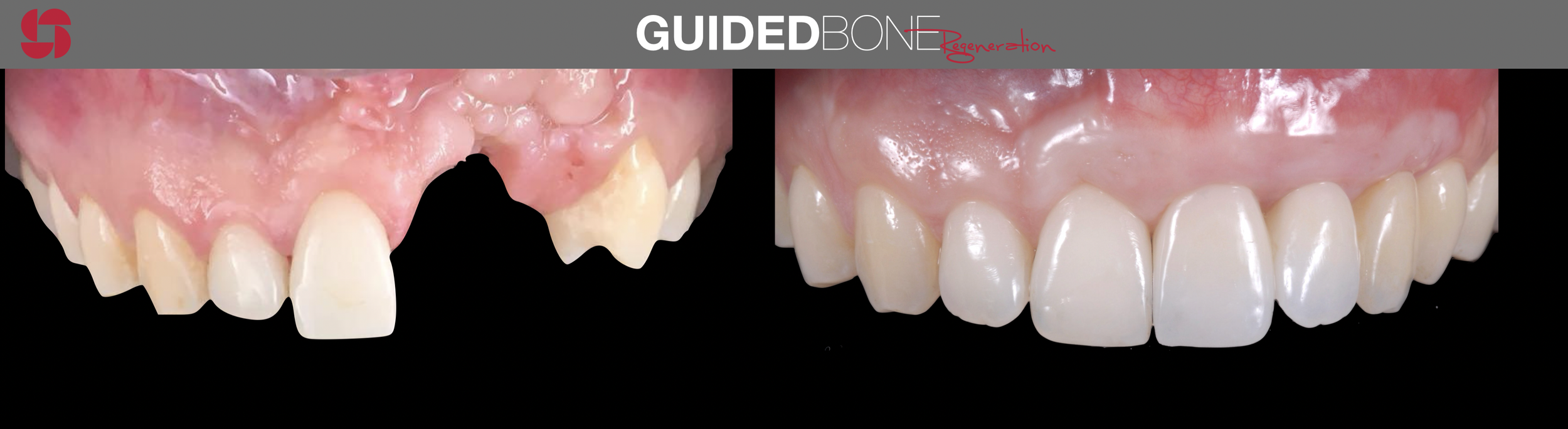 Guided bone regeneration 2.png