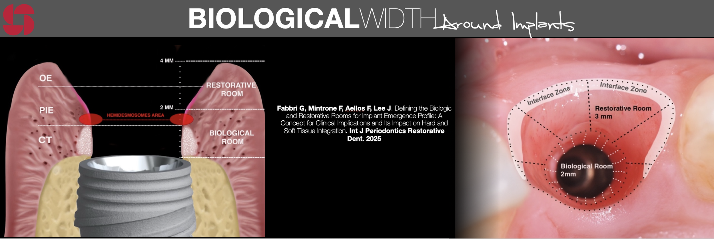 Biological Width 2.png