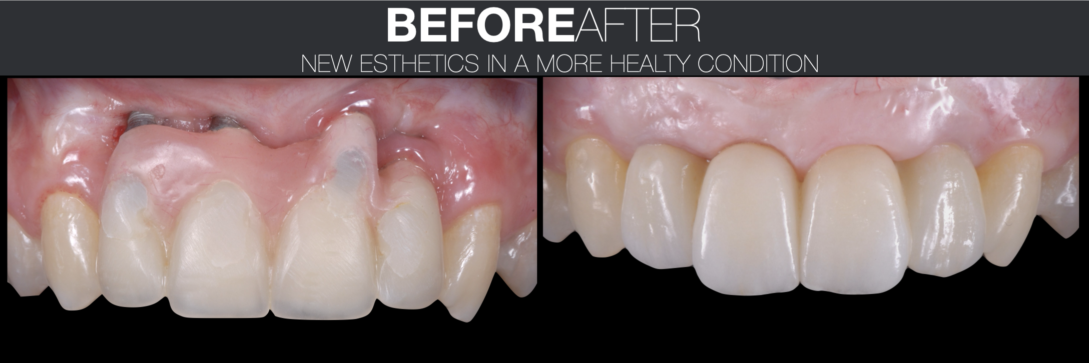 Before After Prosthetic.png