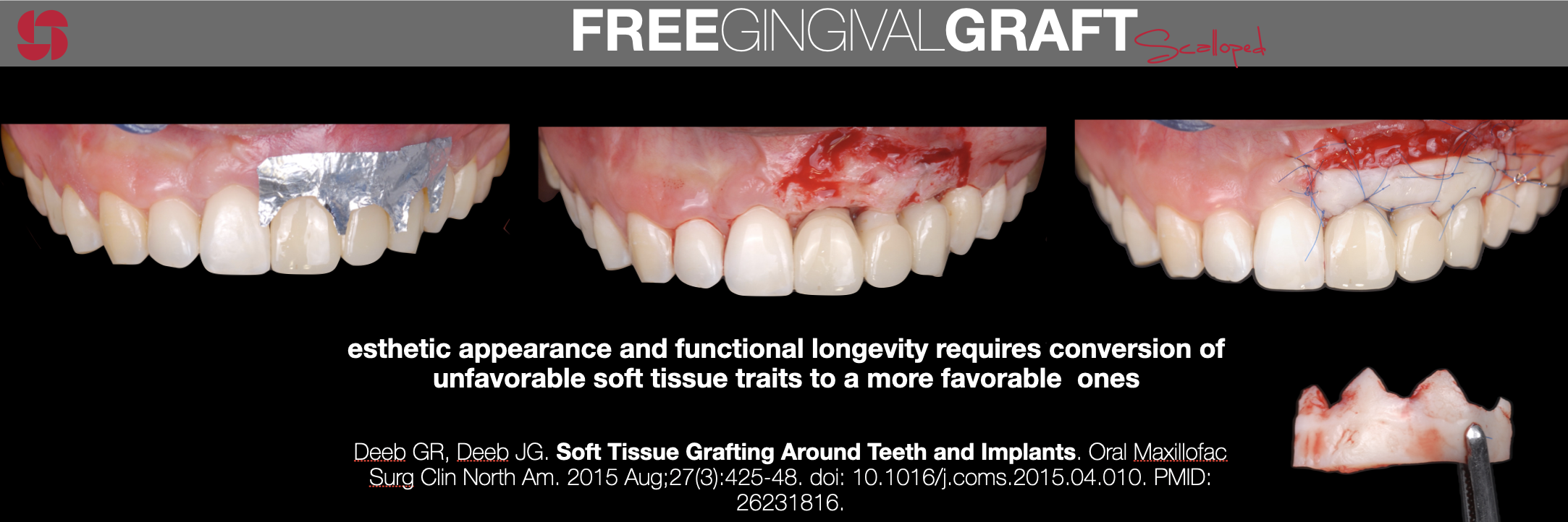 Free Gingival Craft.png