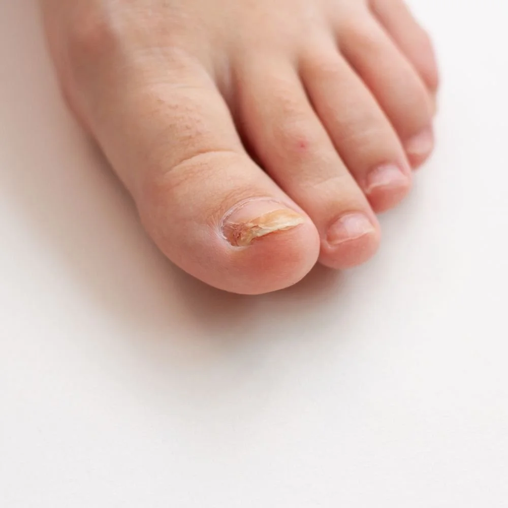 Nahaufnahme eines Fußes mit einem eingewachsenen Zehennagel am großen Zeh.