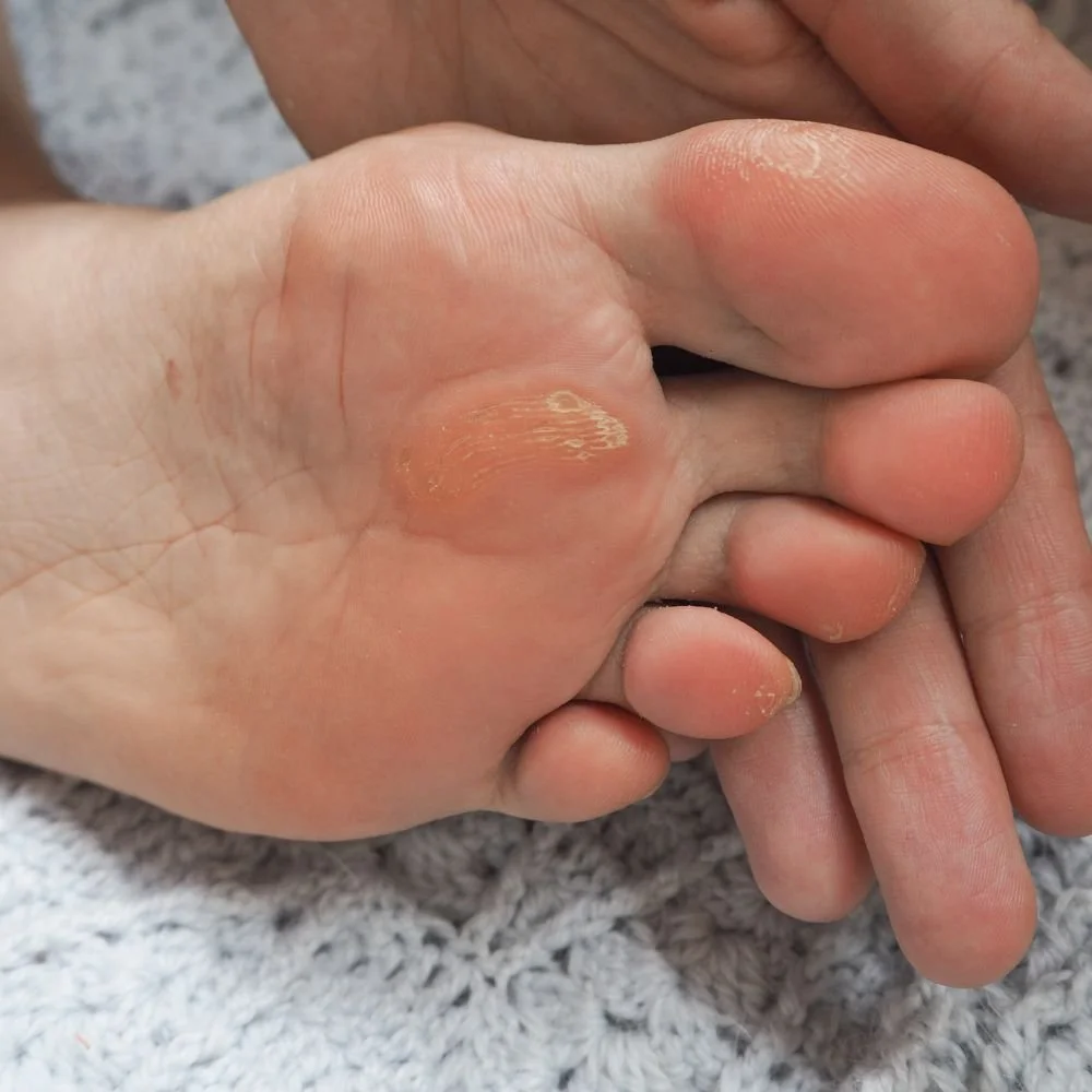 Bild von einem Fuß mit Hornhaut