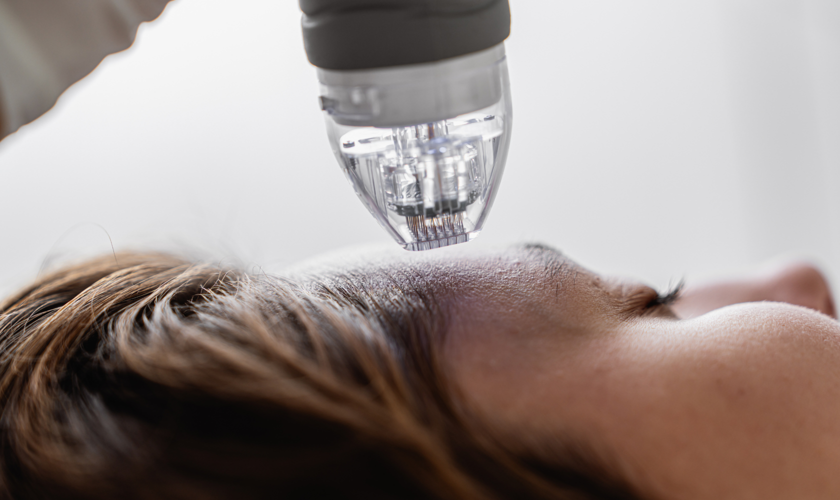 Microneedling in Sthetika Burbank, CA, 91502