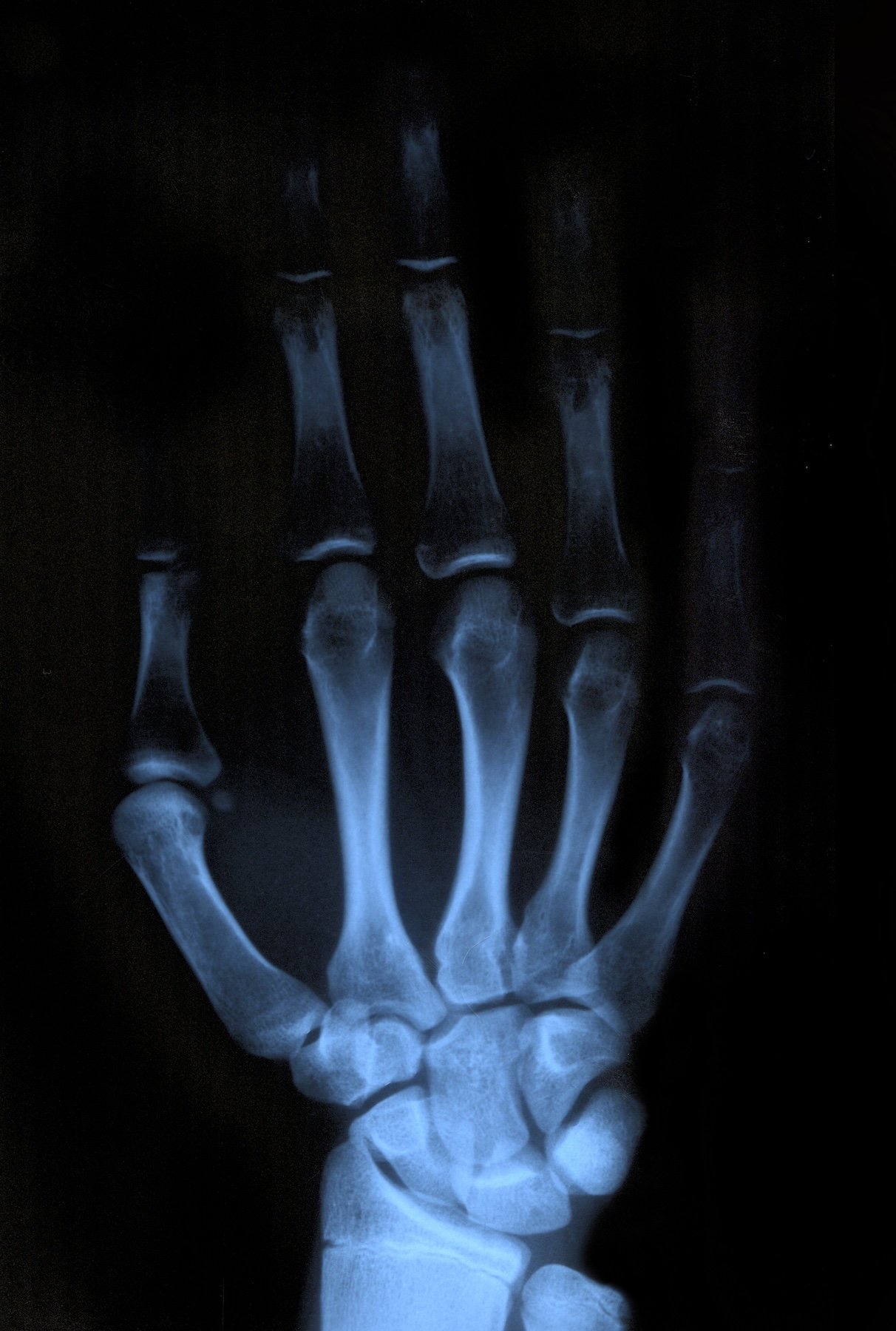 X-ray image of a human hand showing the bones clearly illuminated against a dark background.