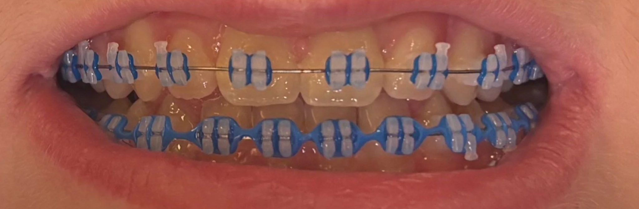 Close-up photo of LightForce braces at 10 weeks with blue bands, showing early alignment progress at Shine Ortho Studio.