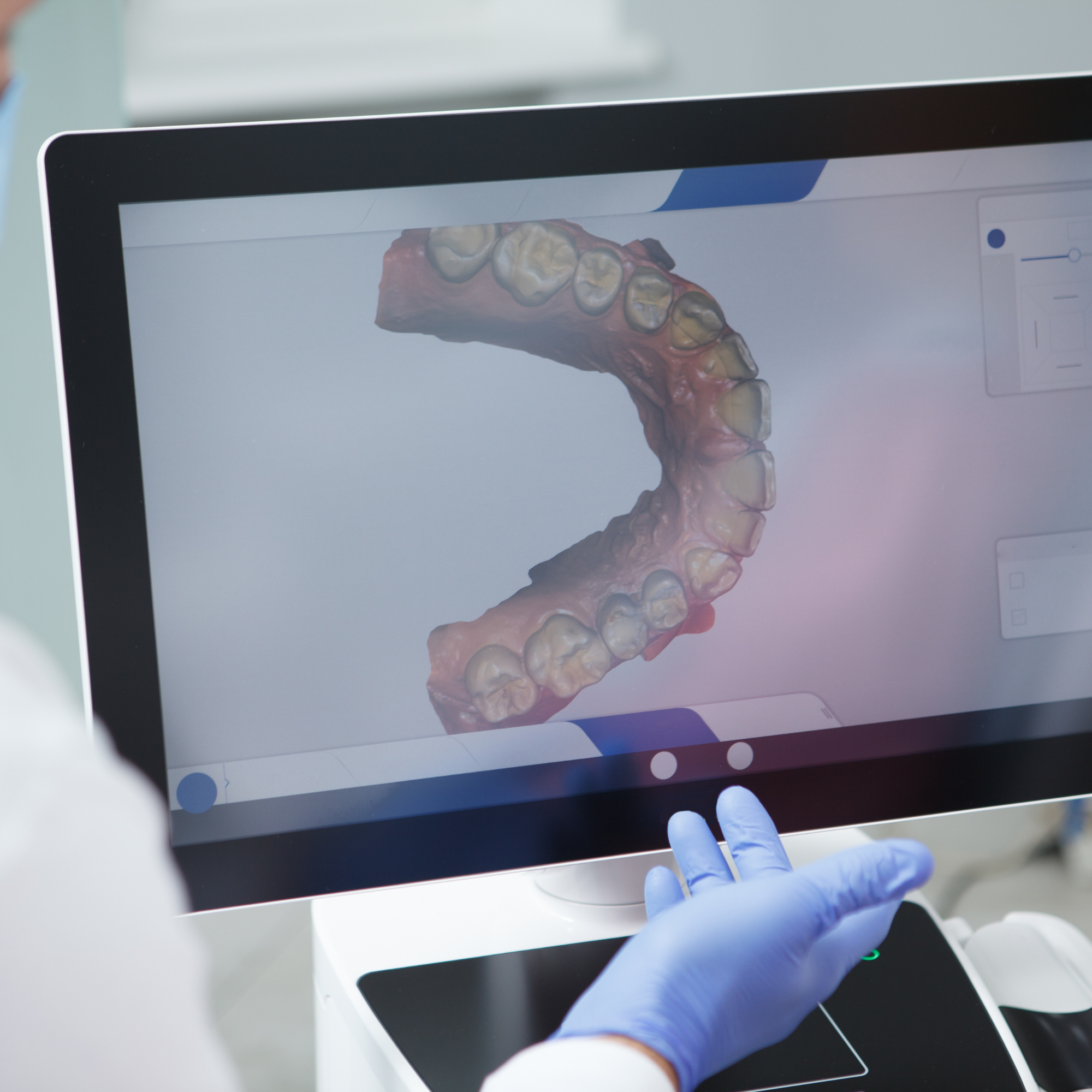 Digital Scanning vs Traditional Impressions