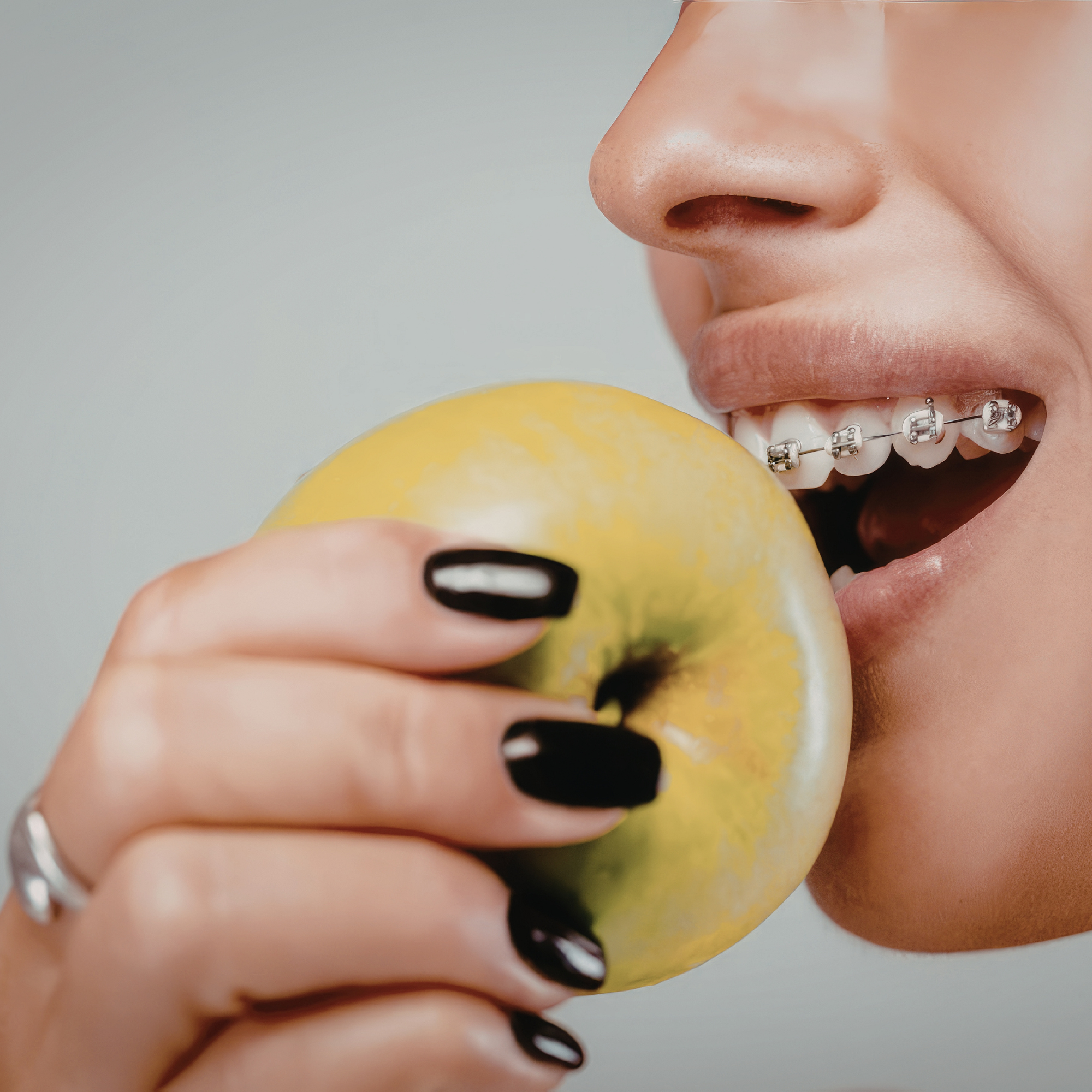 Foods That Are Genuinely Off Limits With Braces (and Why)