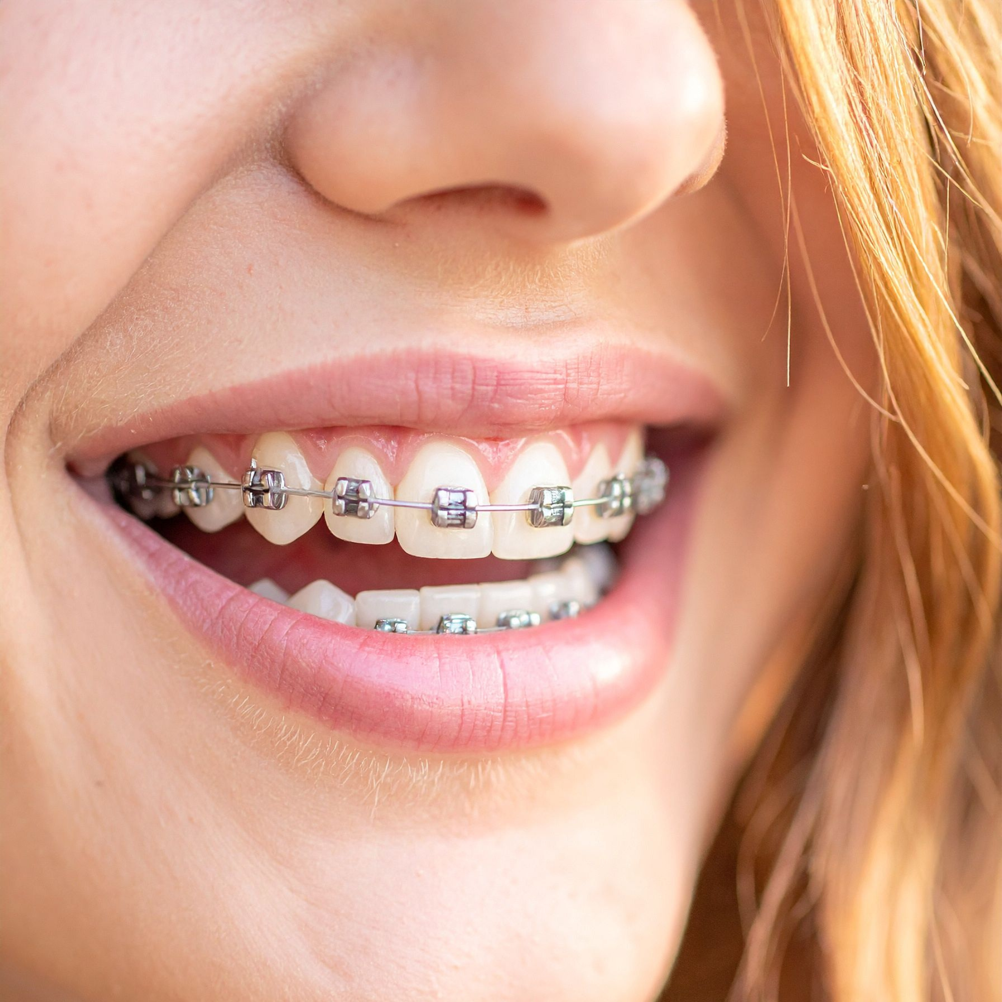 What Are LightForce™ Braces? A Closer Look at Custom 3D-Printed Brackets