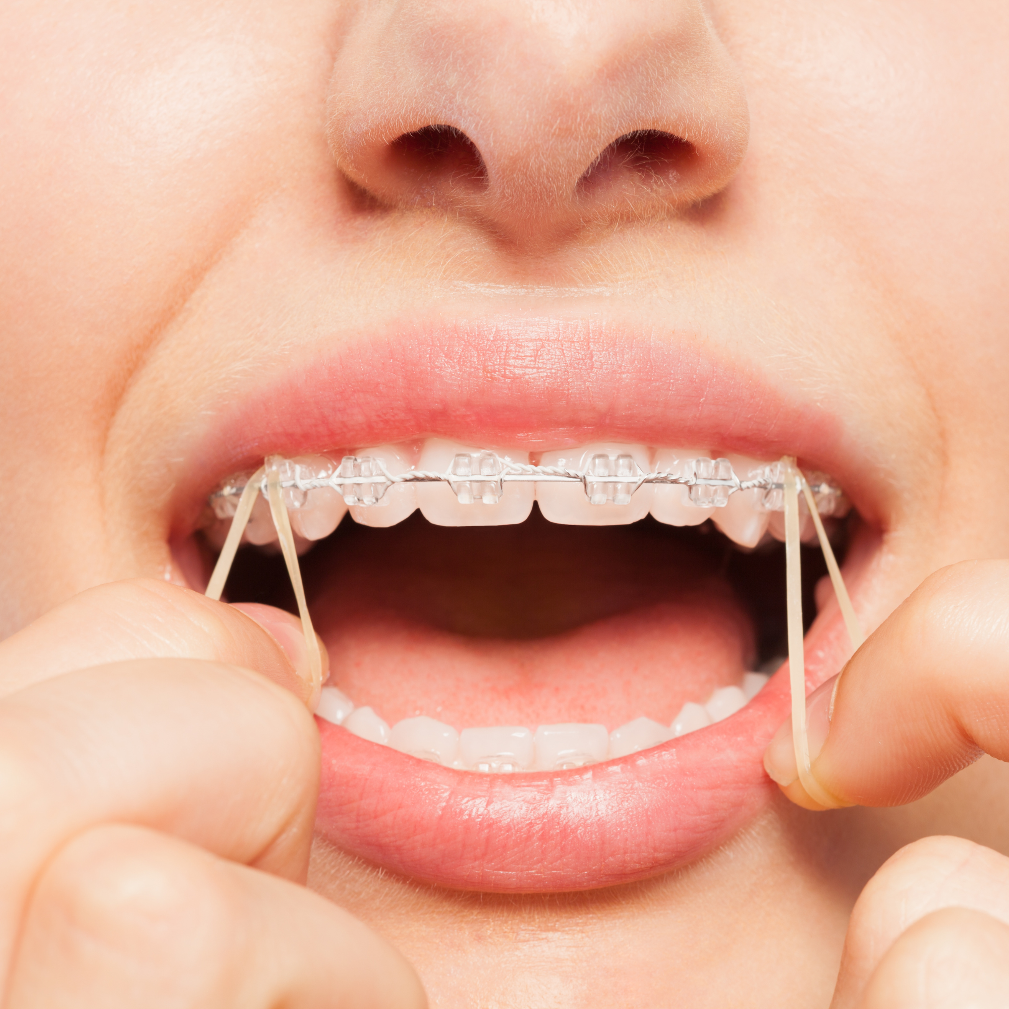 What to Do If Your Child Loses an Elastic Band or Retainer