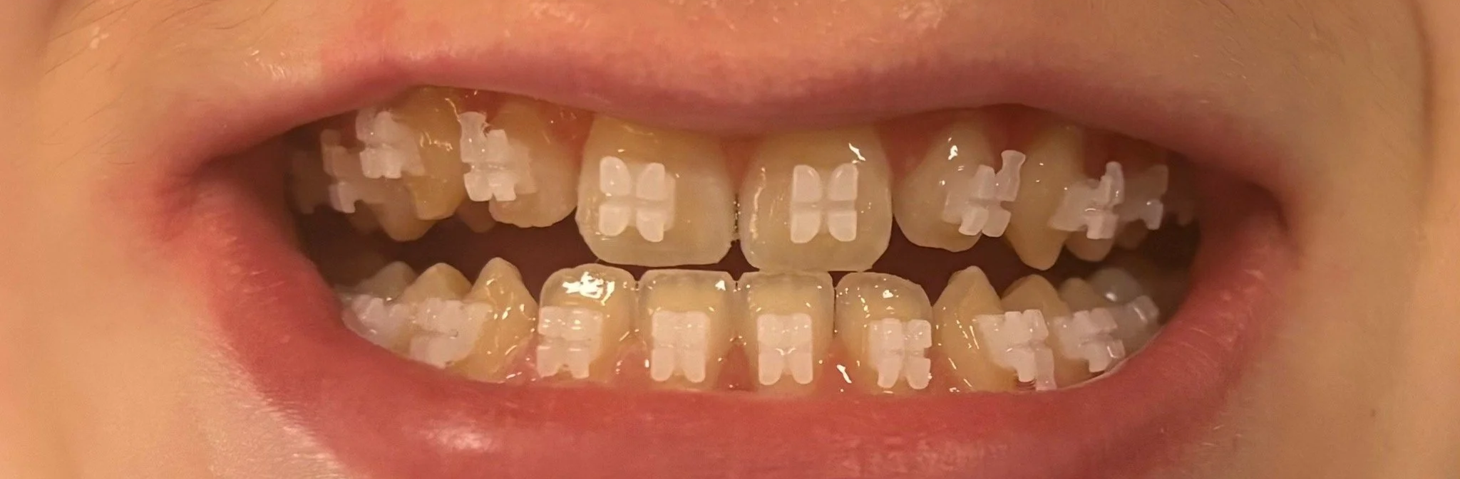 Close-up photo showing LightForce braces on bonding day, highlighting custom 3D-printed brackets at Shine Ortho Studio.