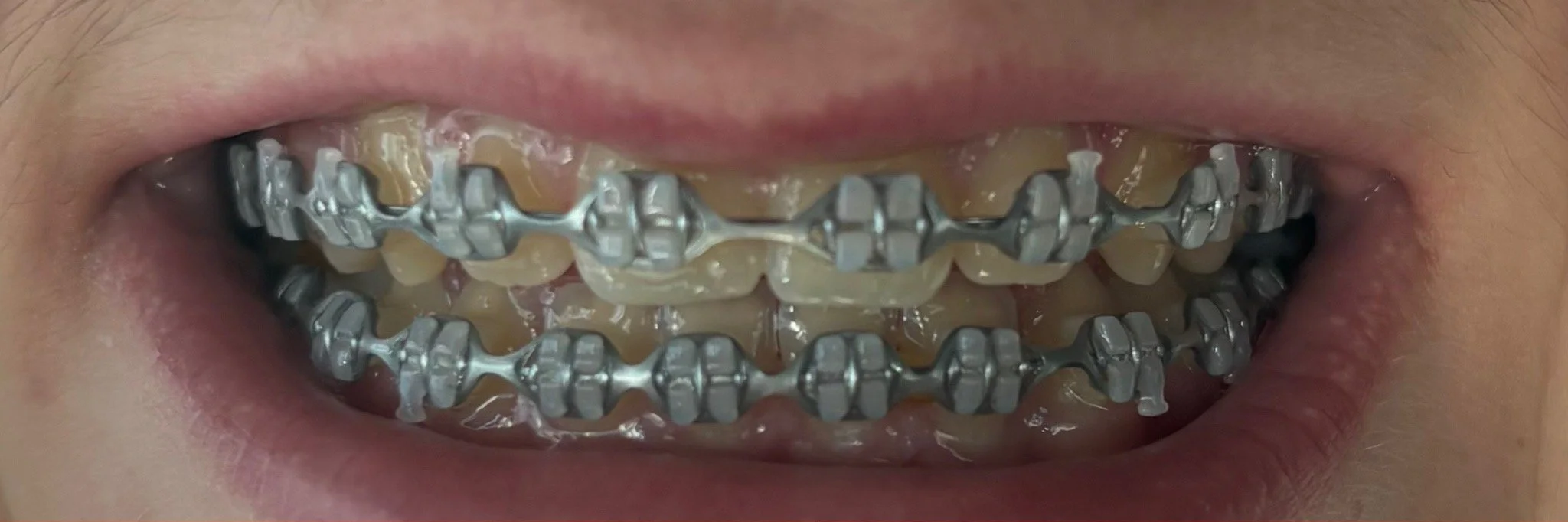 Close-up photo of LightForce braces at 20 weeks with silver bands, showing significant orthodontic improvement at Shine Ortho Studio.