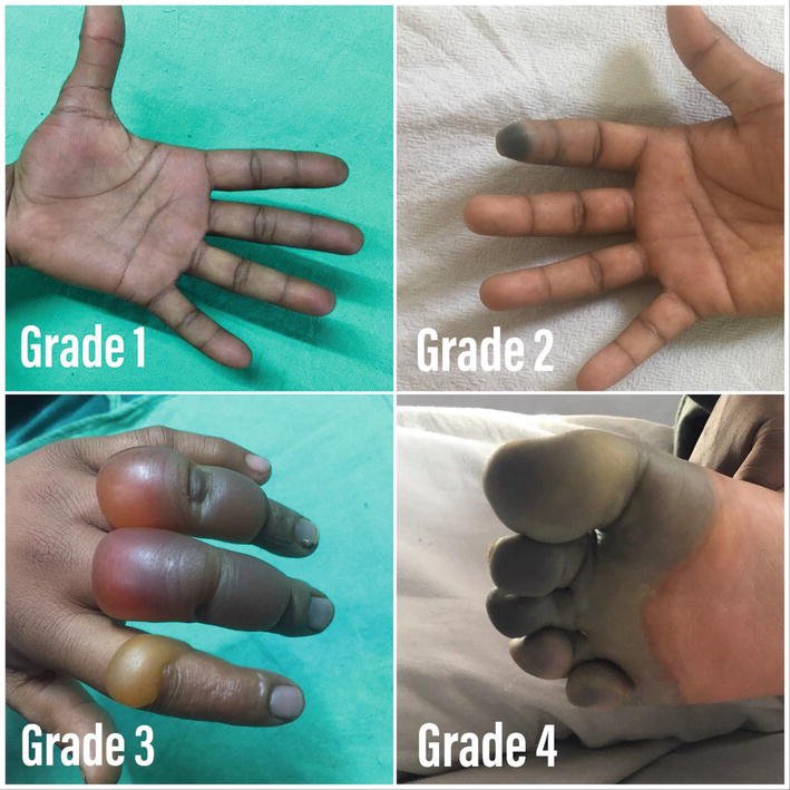 Comparison of four types of finger deformities labeled as Grade 1, Grade 2, Grade 3, and Grade 4, showing progressive worsening of finger deformity.