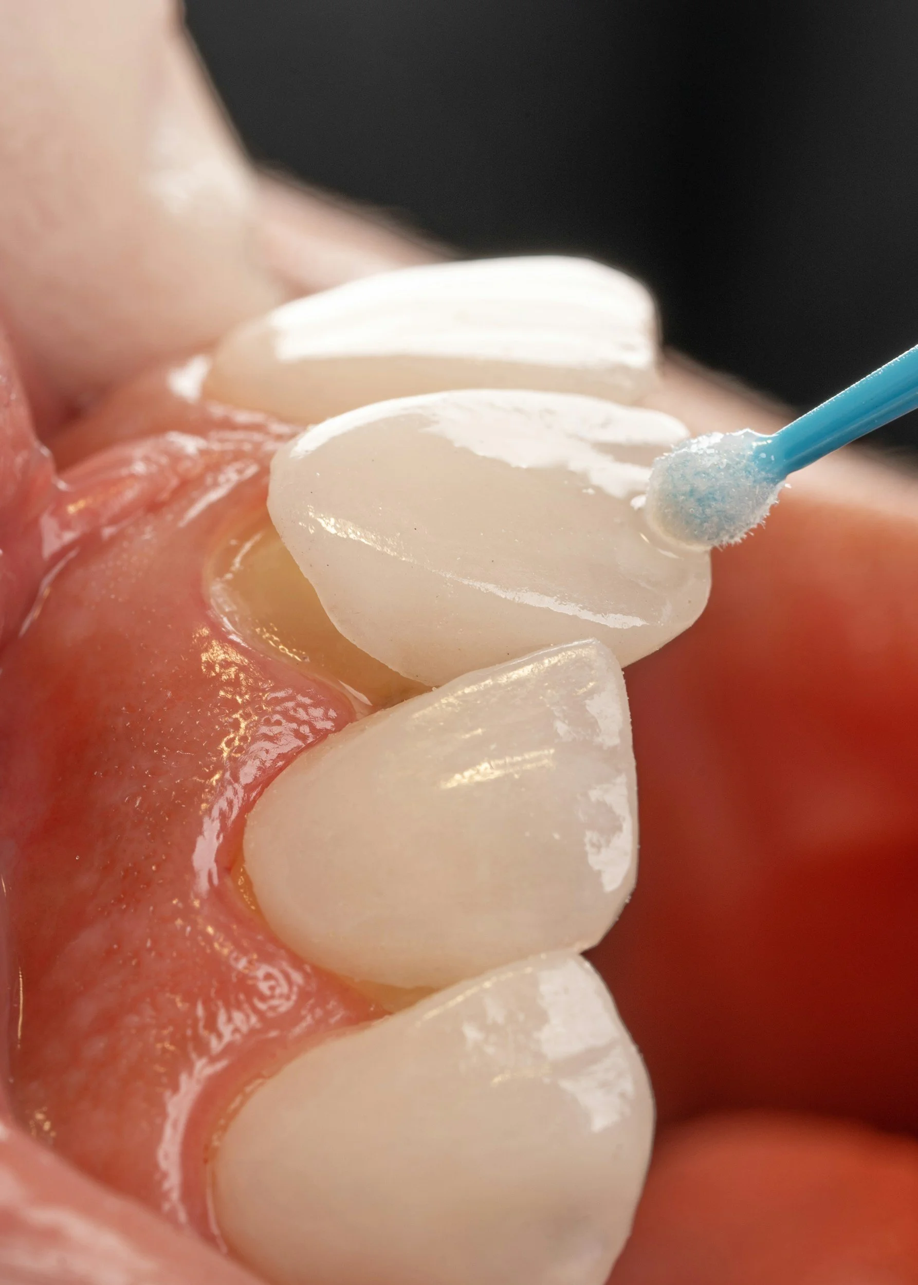 Close-up of dental cleaning, showing teeth and gums, with a dental tool cleaning the teeth.
