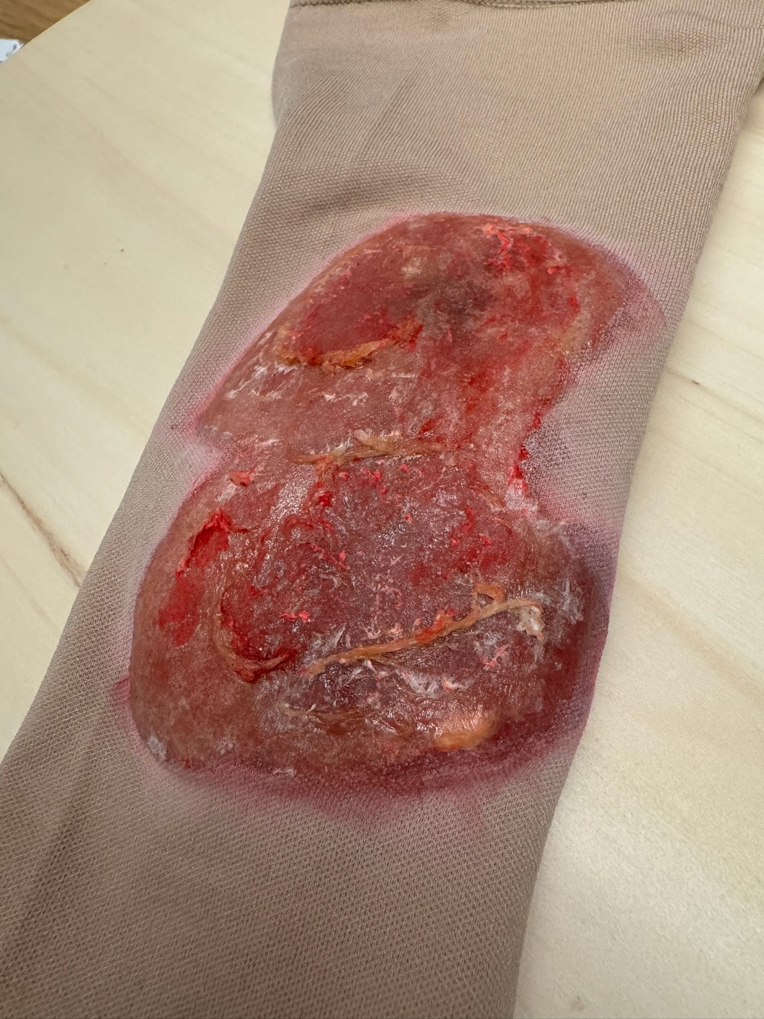 burns sleeve, partial burn, superficial burn, full thickness burn, training aid, first aid fx.