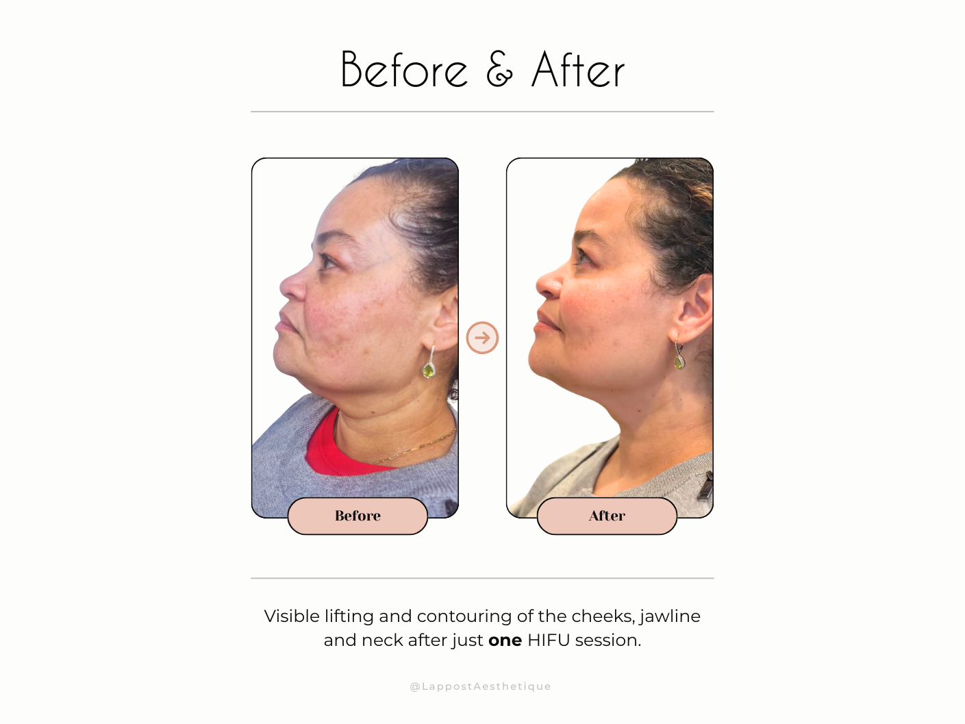 Medspa in Hayward, CA, 94541  Hifu Near Me