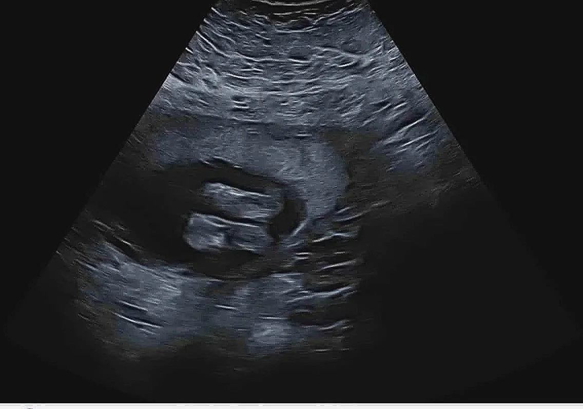 Pregnancy, ADHD &amp; Me: A Very Wiggly Journey (Now With More Chaos!)