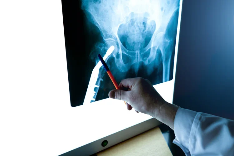 A radiologist’s hands holding and examining an X-ray film of a hip joint, looking for signs of fractures after a high-impact accident.
