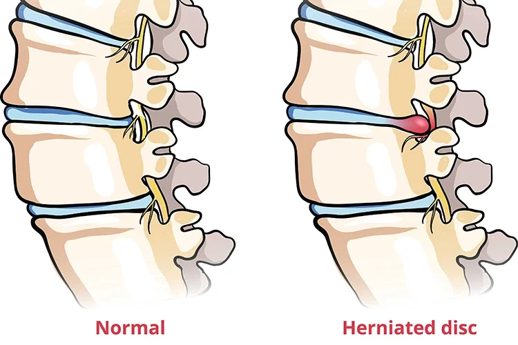 A medical illustration of a herniated disc compressing a nerve root and causing radiating pain down the leg.