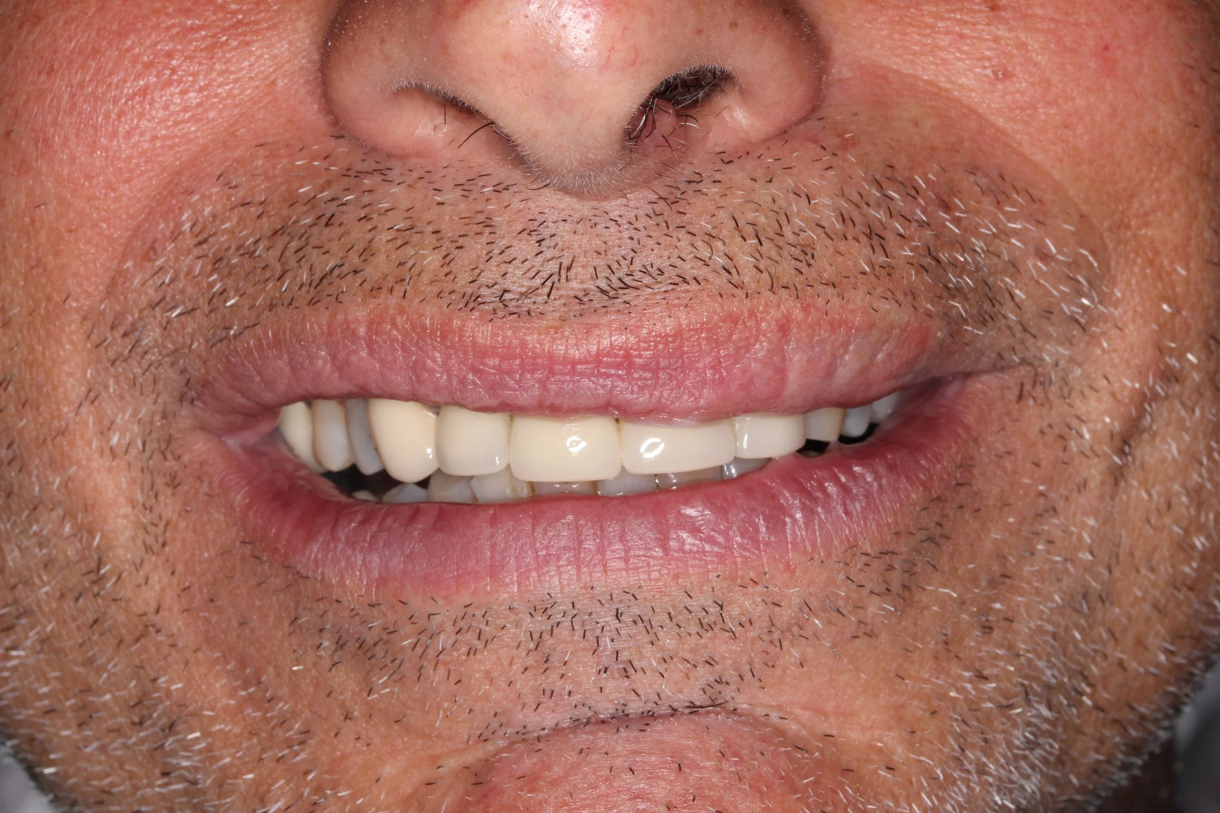 Photo of a smile with teeth that have old crowns that do not match