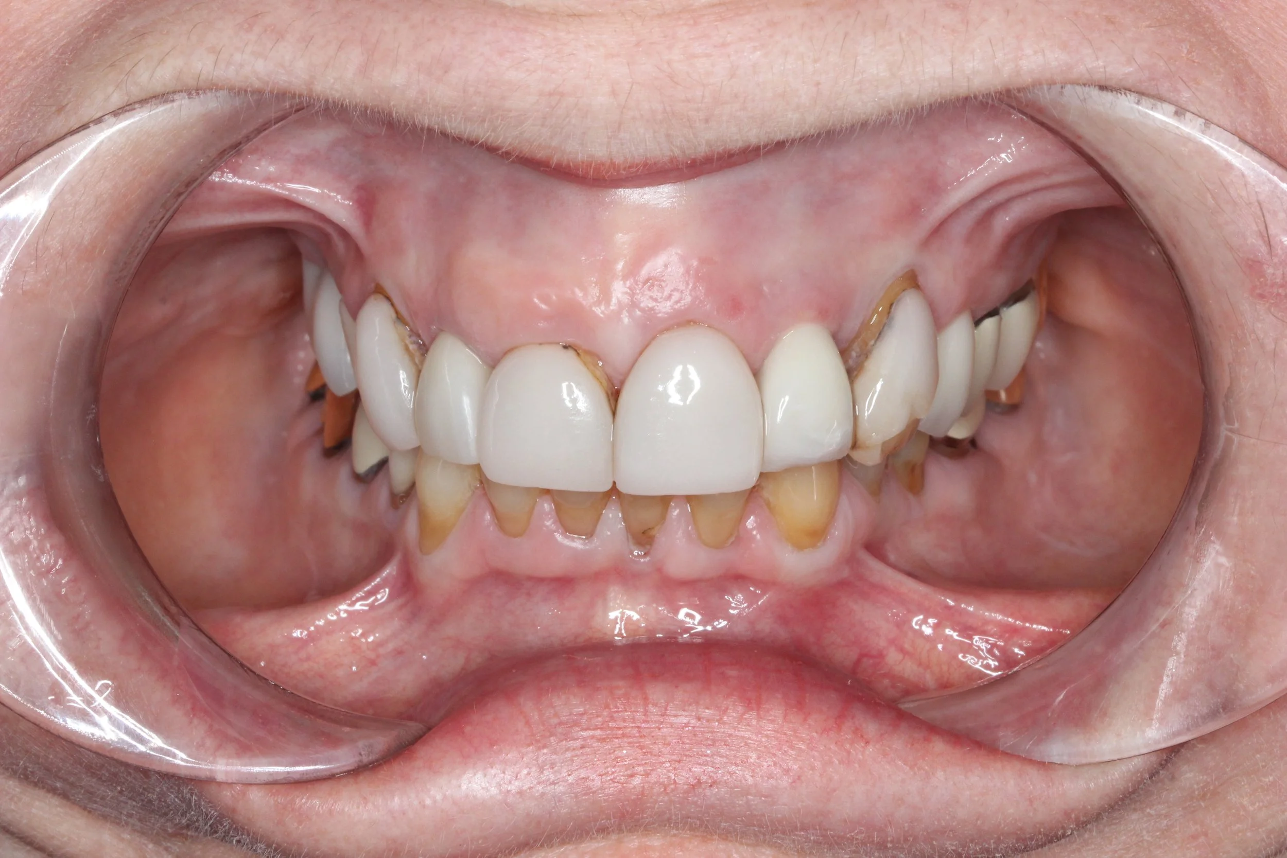 Close-up of a person's open mouth showing teeth with dental crowns and visible plaque and tartar buildup on lower teeth.