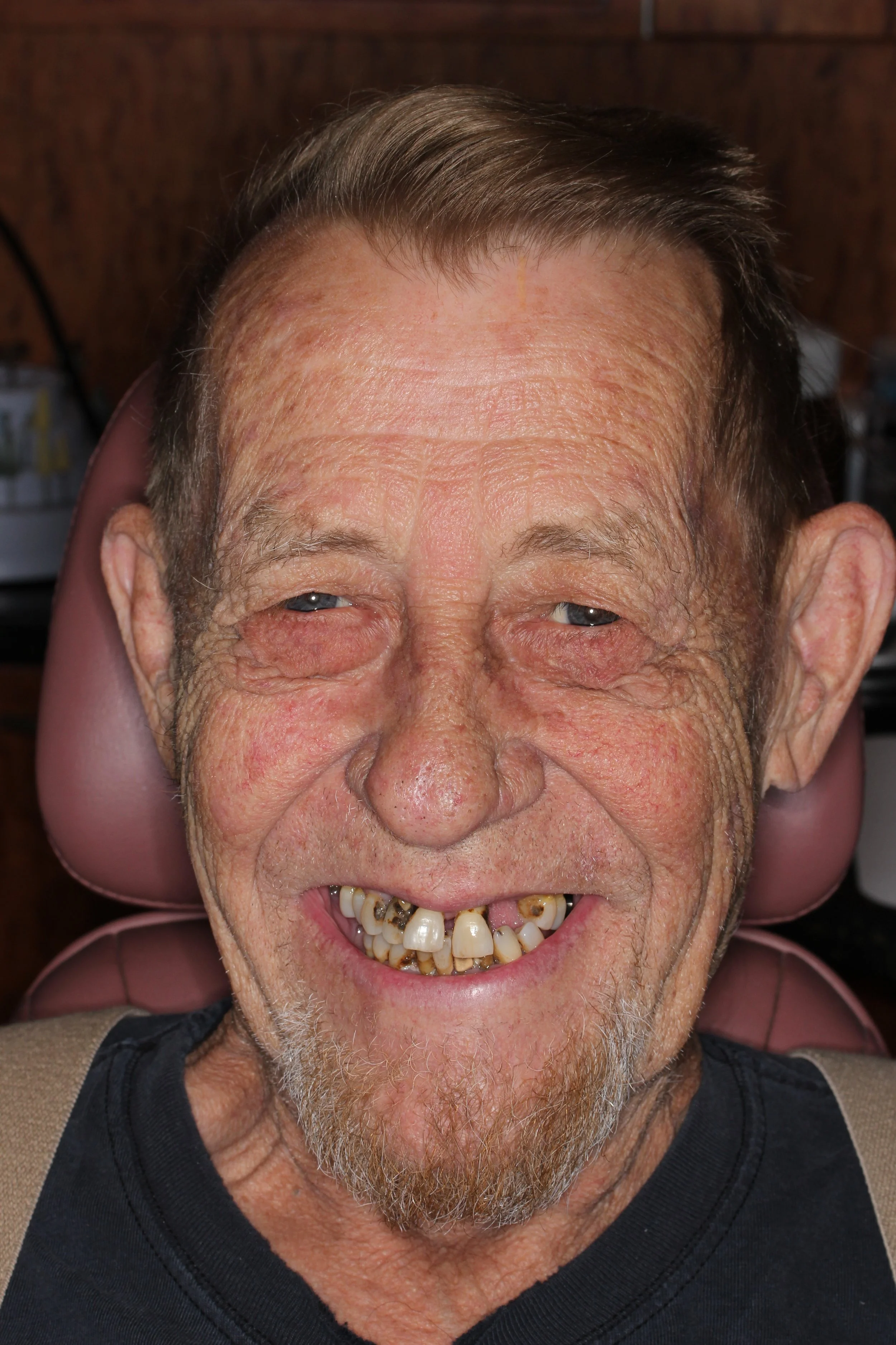 An elderly man with discolored and missing teeth, smiling in a dental chair.