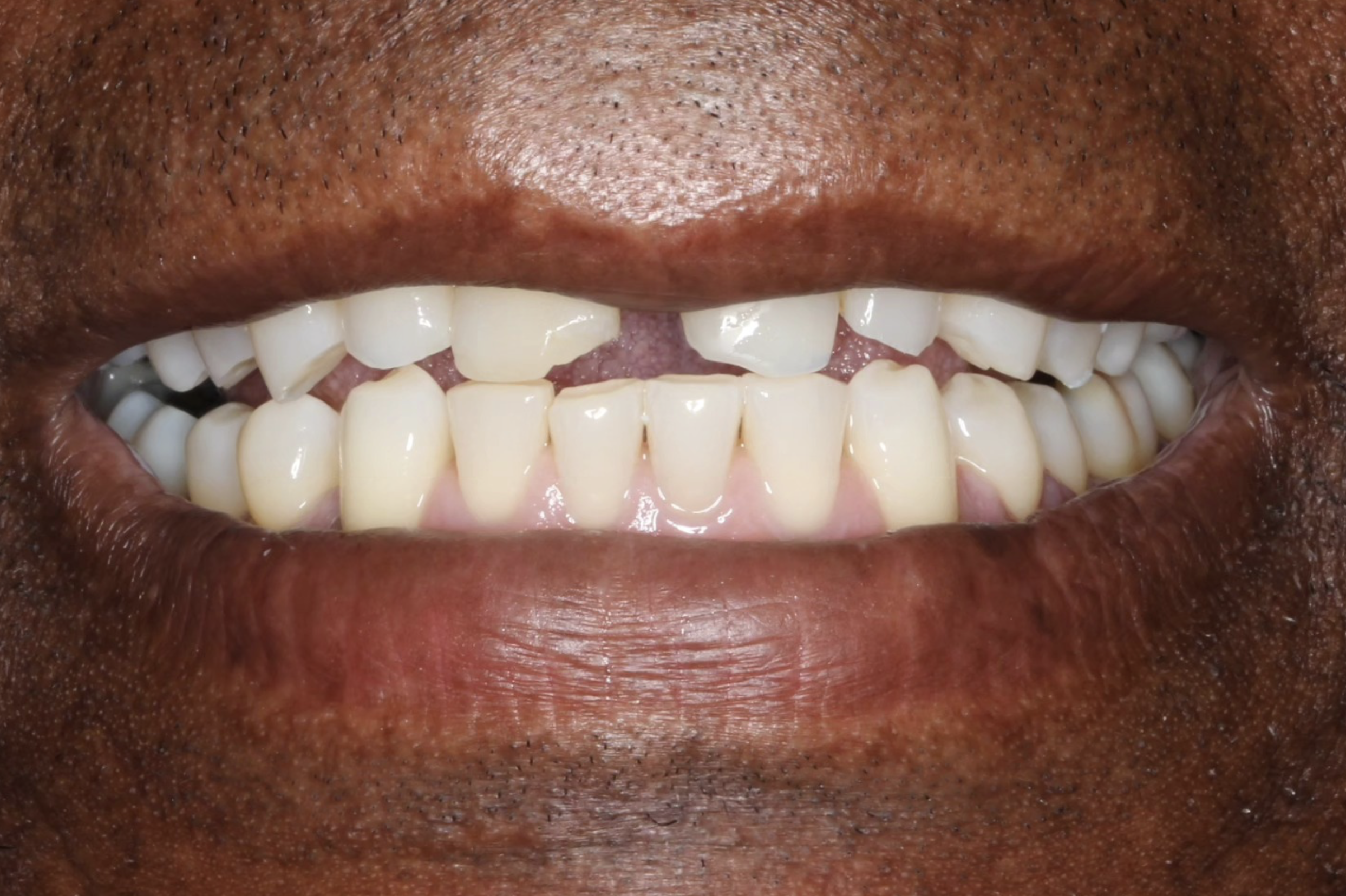 Photo of a smile with teeth that are chipped and have gaps