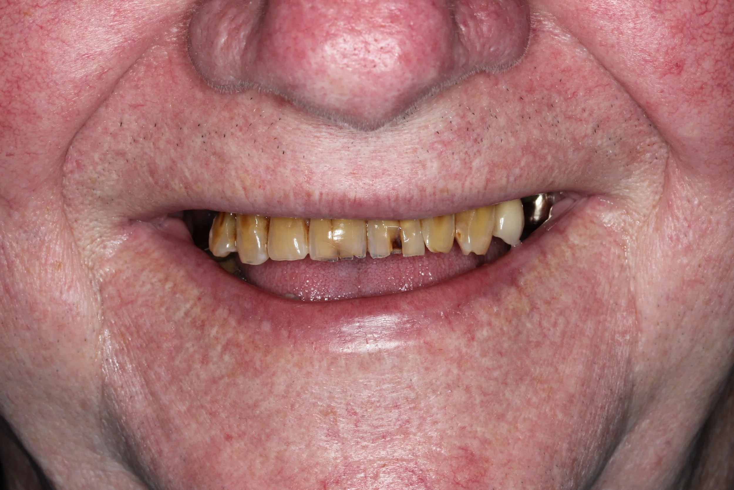 Photo of smile with yellow cracked teeth