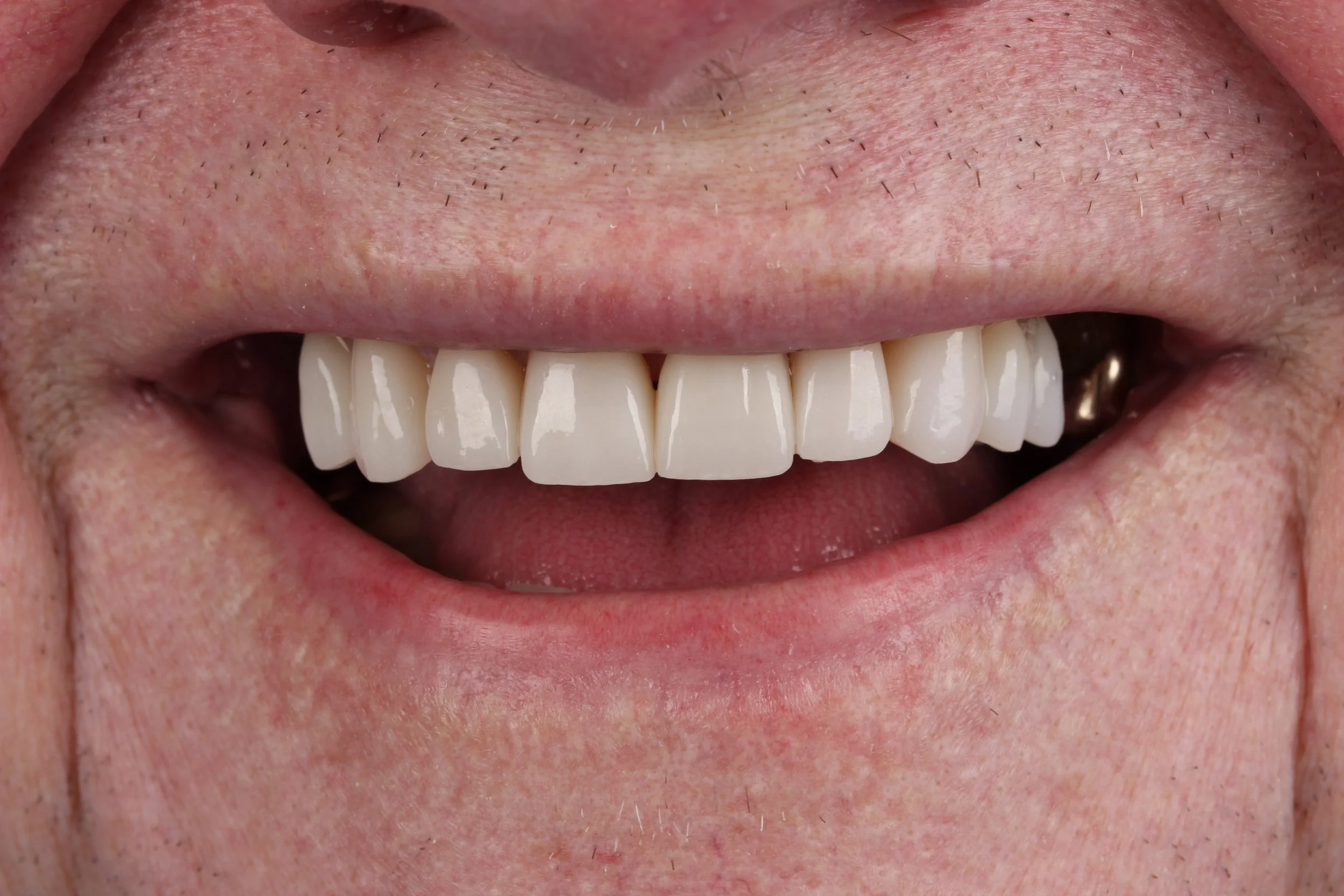 Photo of smile with teeth that are pretty, white, and aligned