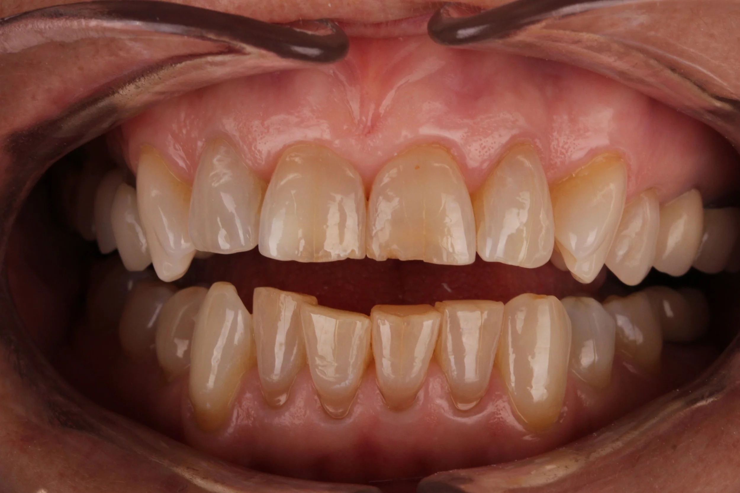 Close-up of a person's open mouth showing yellowed and stained teeth with multiple gaps and uneven edges.