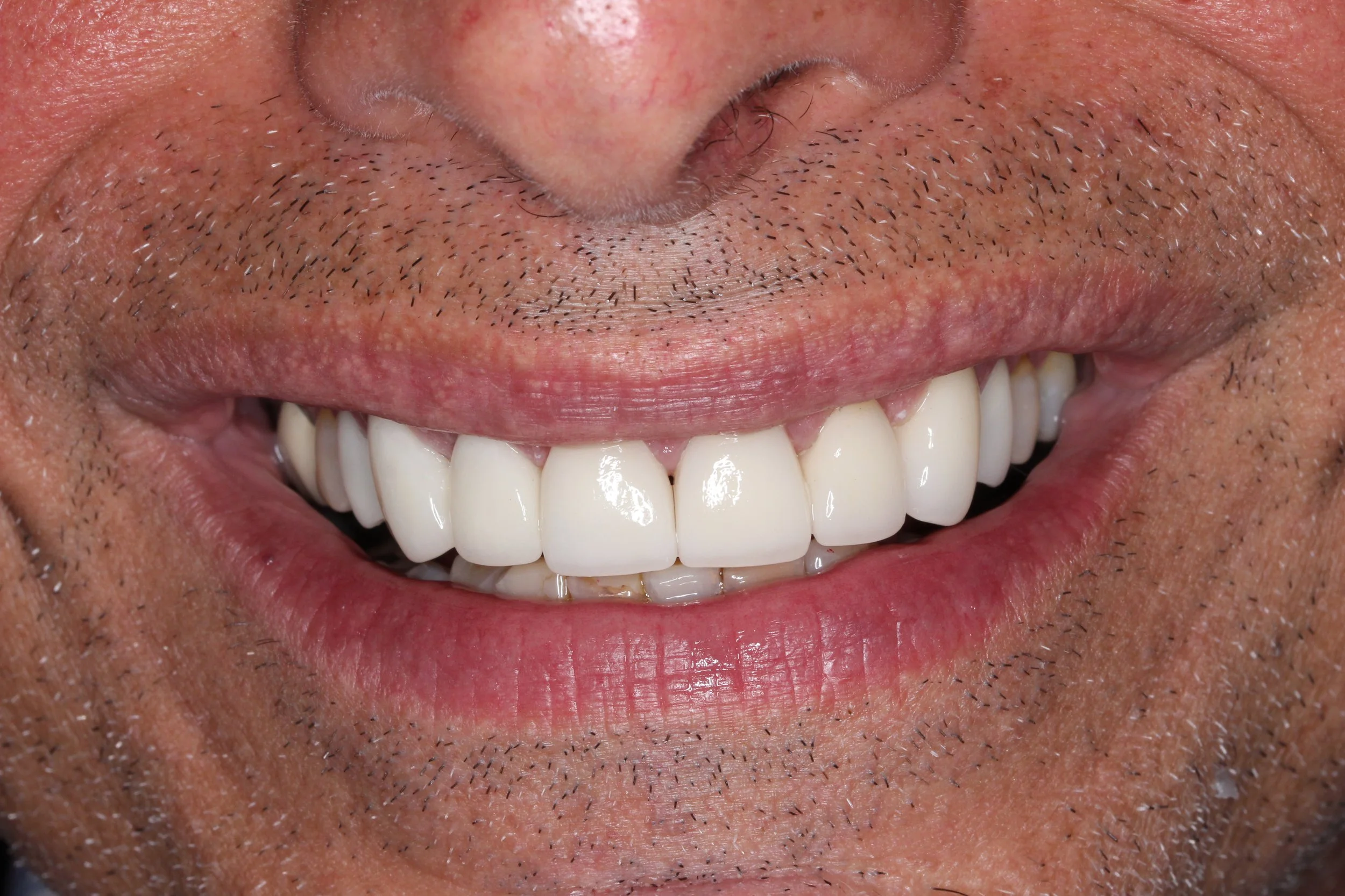 Photo of a smile with beautiful teeth
