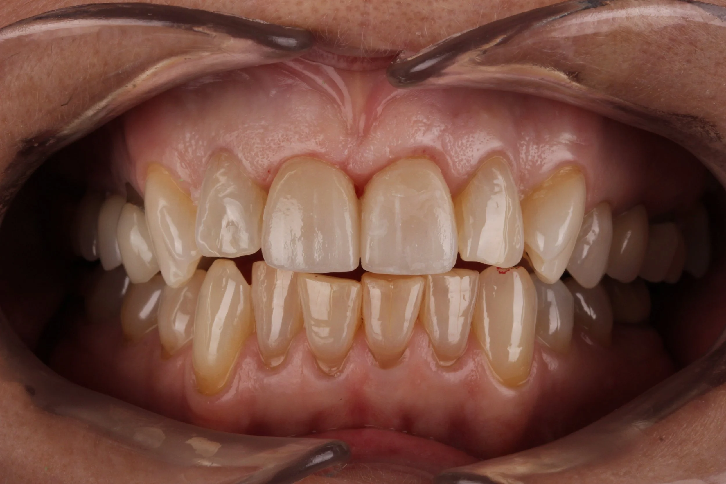 Close-up of a person's teeth showing a mix of natural teeth and dental restorations, with some gaps and discoloration.
