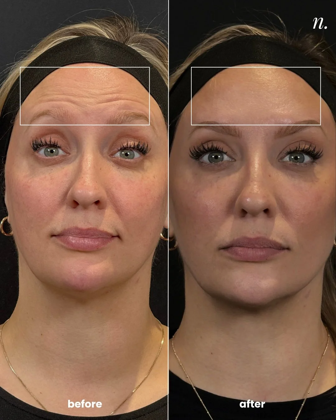 Can you spot everything that changed?

Softened forehead lines, a more relaxed brow, refreshed eyes, a smoother chin, and a subtle lift at the corners of the mouth.

84 units. Movement preserved. Still completely her.