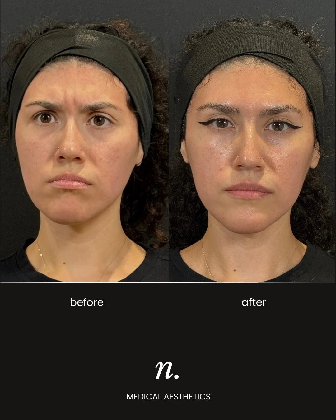 &ldquo;I feel SO confident.&rdquo; 🤎

The first thing she told us at her follow-up, and exactly what we love to hear.

She came to us after previously receiving just over 20 units of Botox across multiple areas. Her results lasted about 4-6 weeks, a