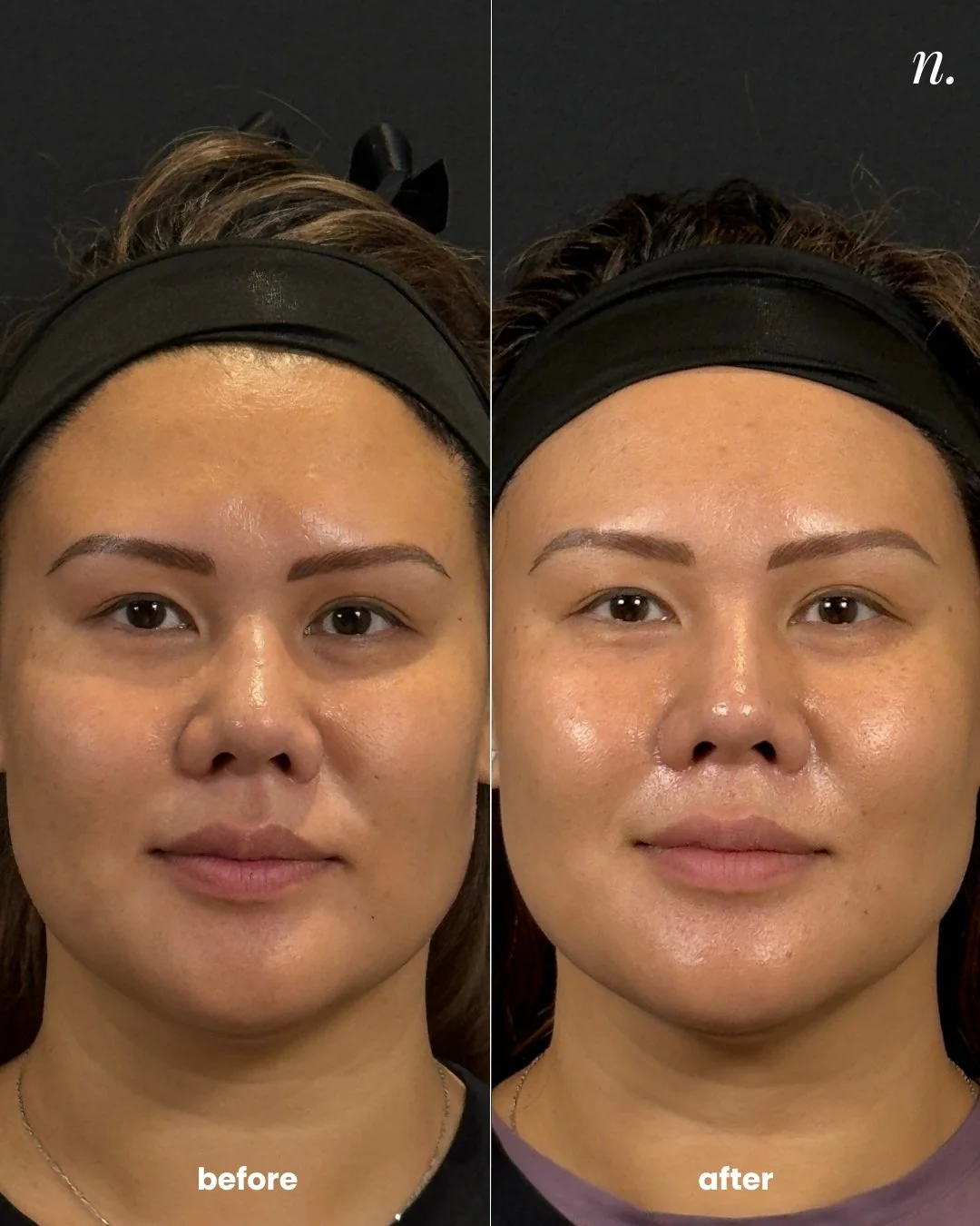If your skin looks dull, feels uneven to the touch, or your makeup seems to emphasize texture you wish it didn&rsquo;t...

These results are after one session of The Narcissus Standard | Microneedling.

Smoother-looking texture. Brighter, more even-l